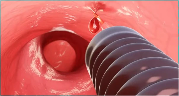 Polyps and early cancer changes (screening value)