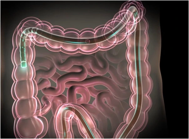What is a colonoscopy?