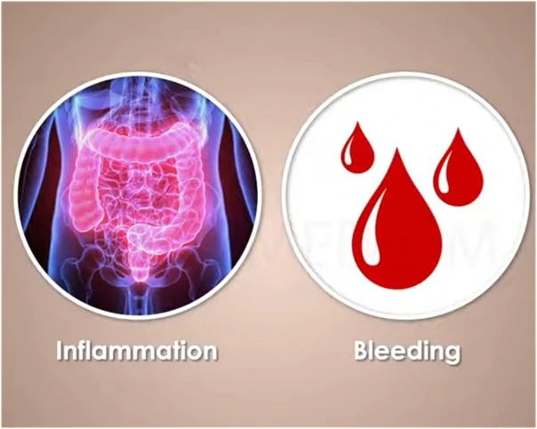 The main benefit of colonoscopy for colon cancer screening is detecting polyps